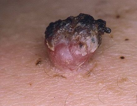 feketézett papilloma