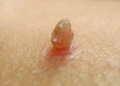 Éles papilloma
