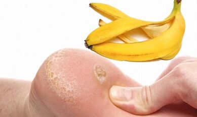 Banánhéj egy planta szemölcs kezelésére