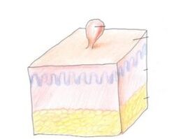 hogyan lehet megszabadulni a papillómától a testen