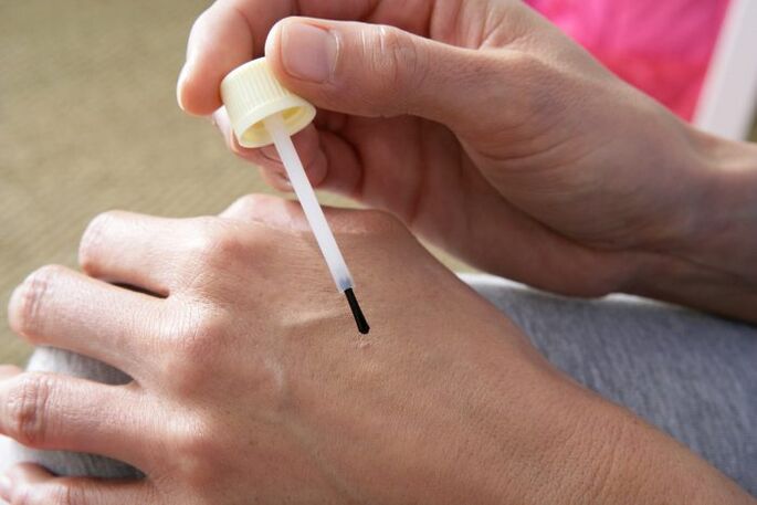 a szemölcsök cauterizálása celandinlével
